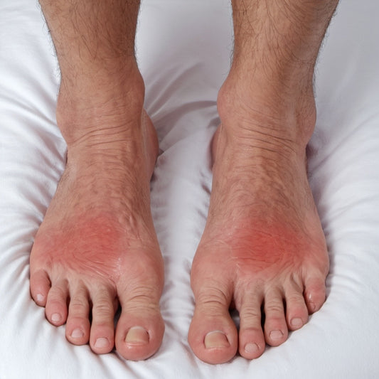 Redness in a man's feet due to gout 